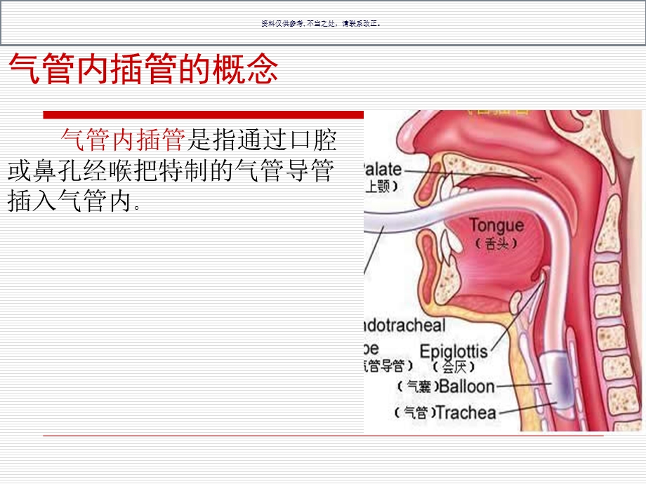 气管插管术医学宣教课件.ppt_第1页