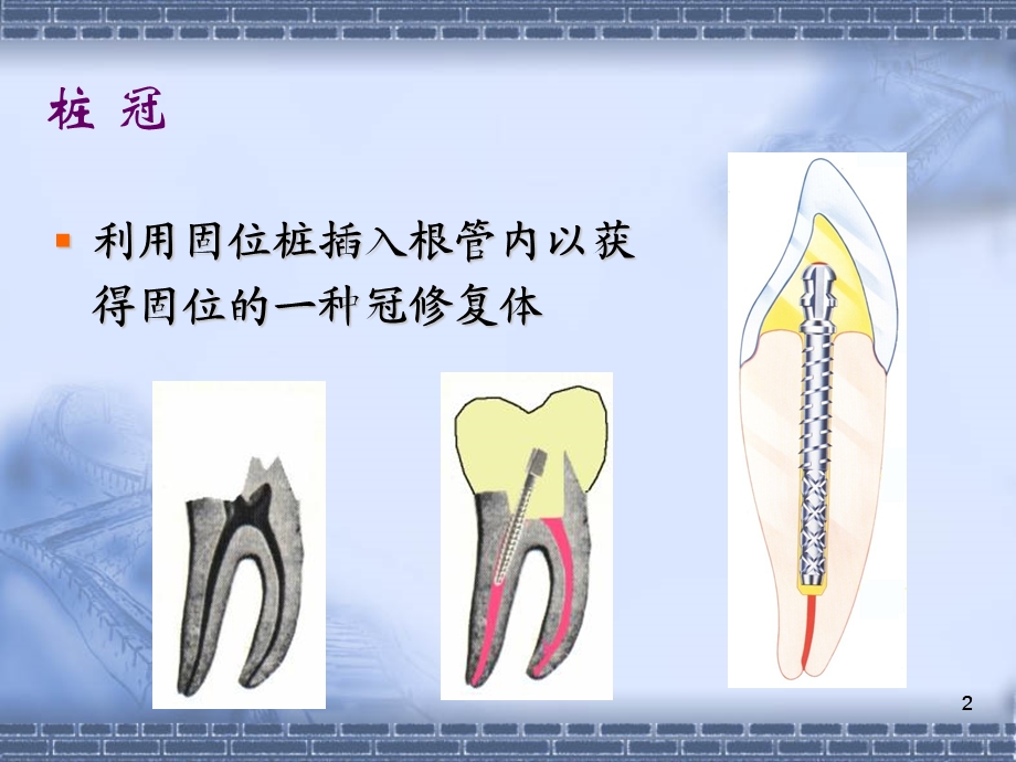 桩核冠 贴面课件.ppt_第2页