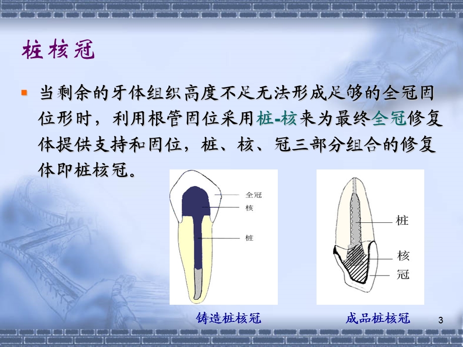 桩核冠 贴面课件.ppt_第3页