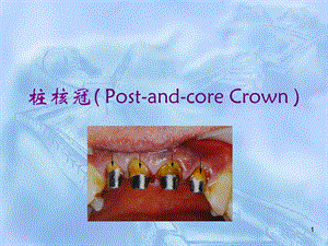 桩核冠 贴面课件.ppt