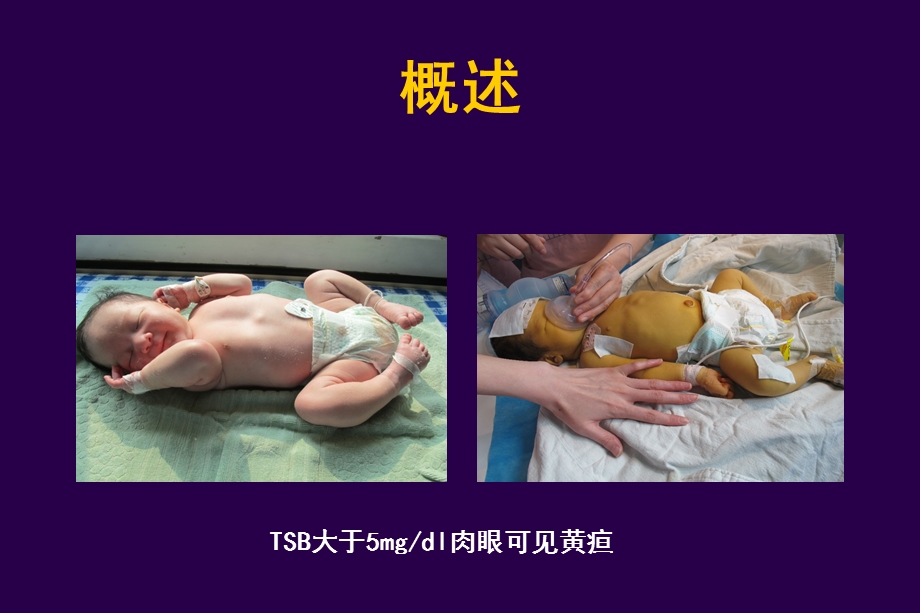 新生儿黄疸科室讲课课件.ppt_第3页