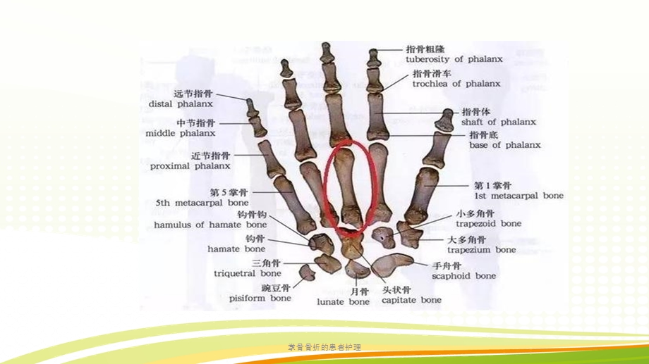 掌骨骨折的患者护理课件.pptx_第3页