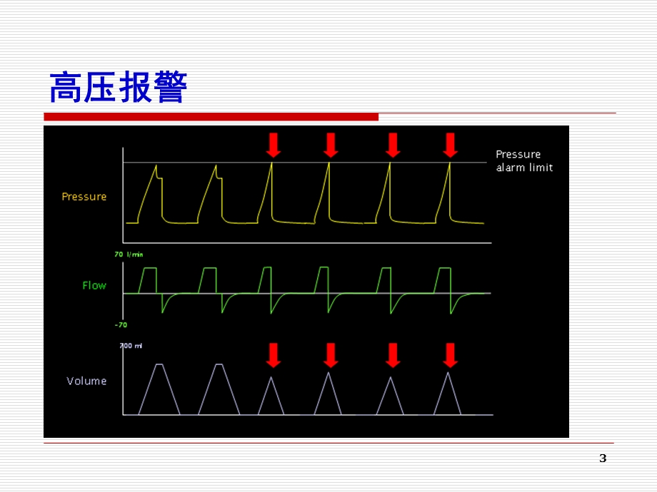 有创通气常见临床问题的处理ppt课件.ppt_第3页