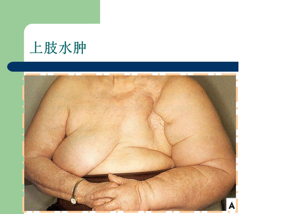 乳腺前哨淋巴结活检技术乳腺外科的又一次“革命”.ppt.ppt_第3页