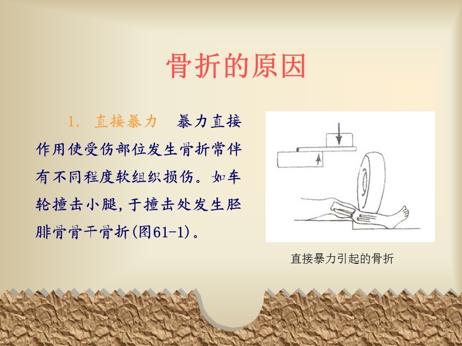 骨折的现场急救PPT.ppt_第3页