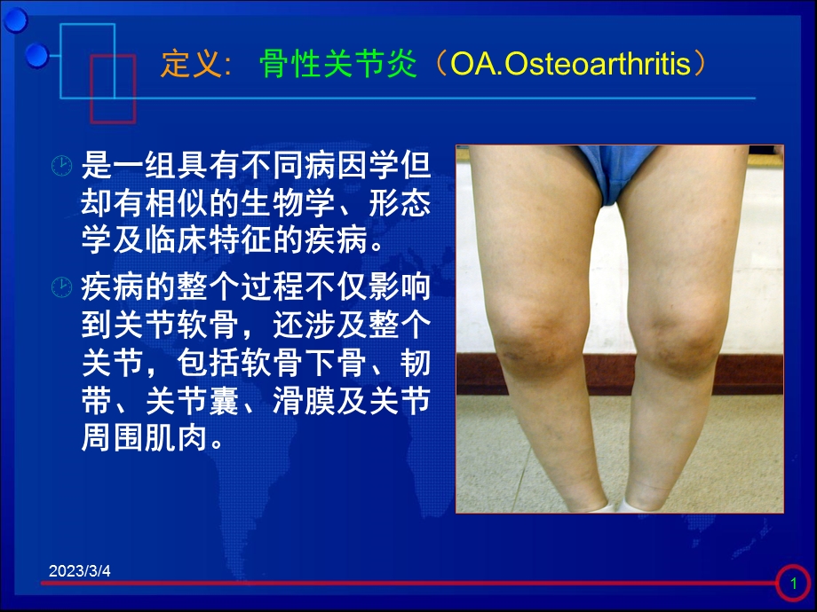 膝关节骨关节炎治疗进展.ppt_第2页