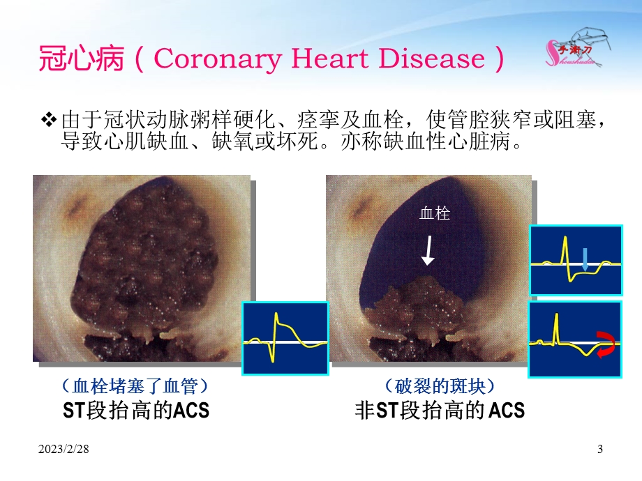 冠心病的超声诊断思维要点.ppt_第3页