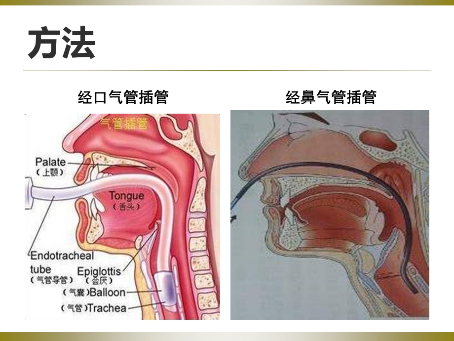 气管插管的护理.ppt_第3页