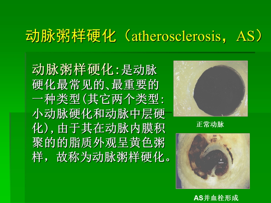 冠心病稳定型心绞痛幻灯片.ppt_第2页