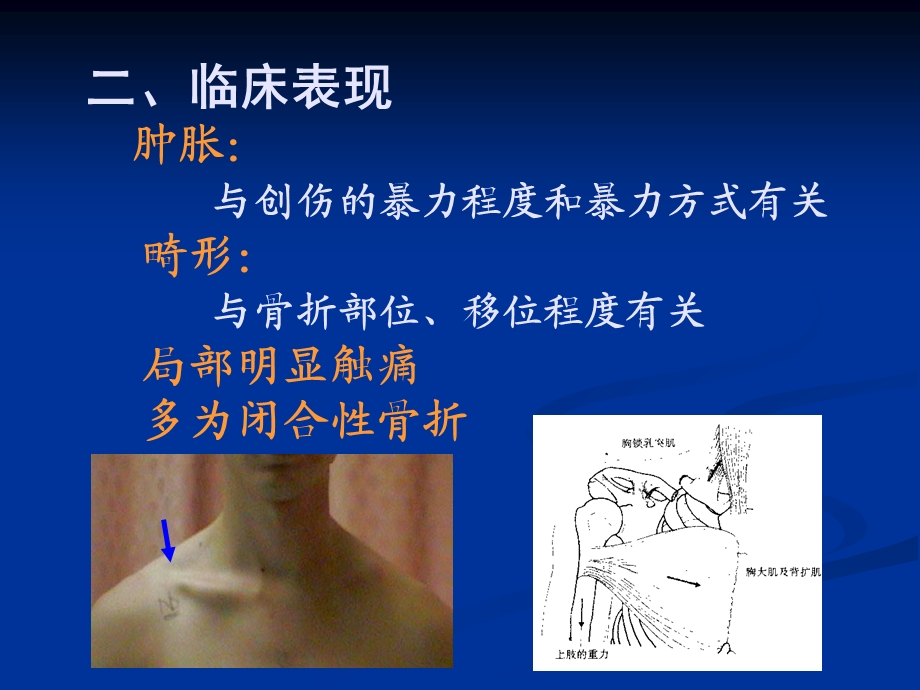 【骨科学课件】11锁骨骨折.ppt_第3页