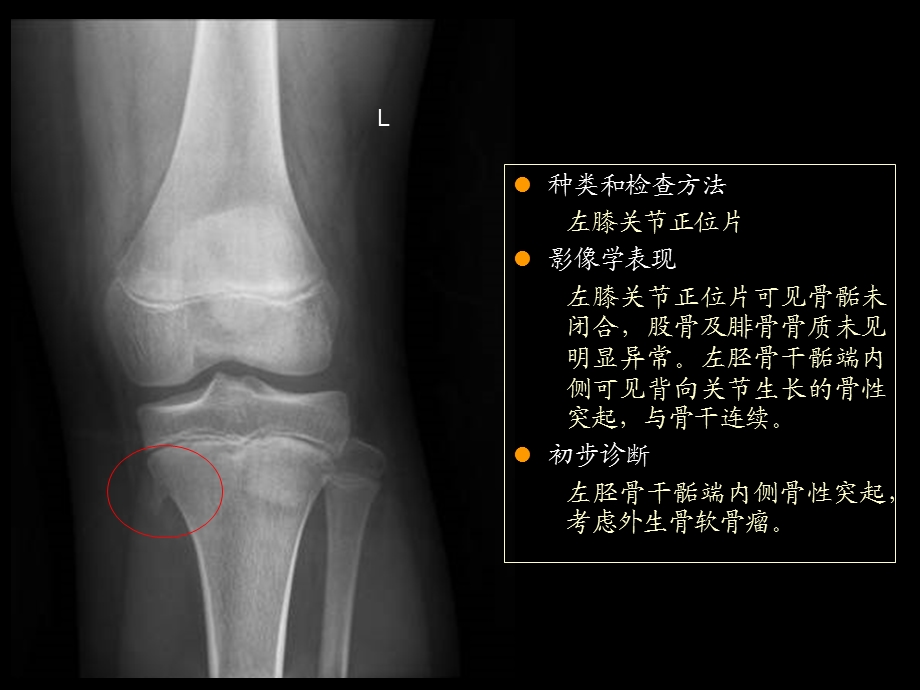 OSCE影像(骨折).ppt_第2页