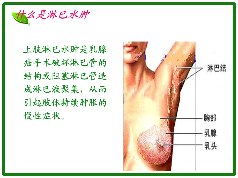 乳腺癌术后淋巴水肿的预防模板.ppt_第3页