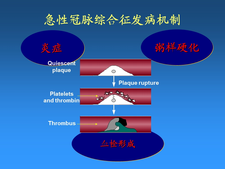 泰嘉在ACS & PCI术中的应用.ppt_第3页