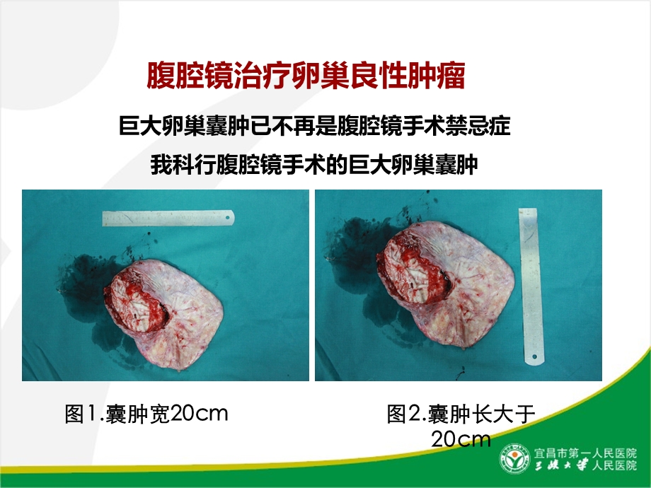 妇科腹腔镜现状思考与展望.ppt_第3页