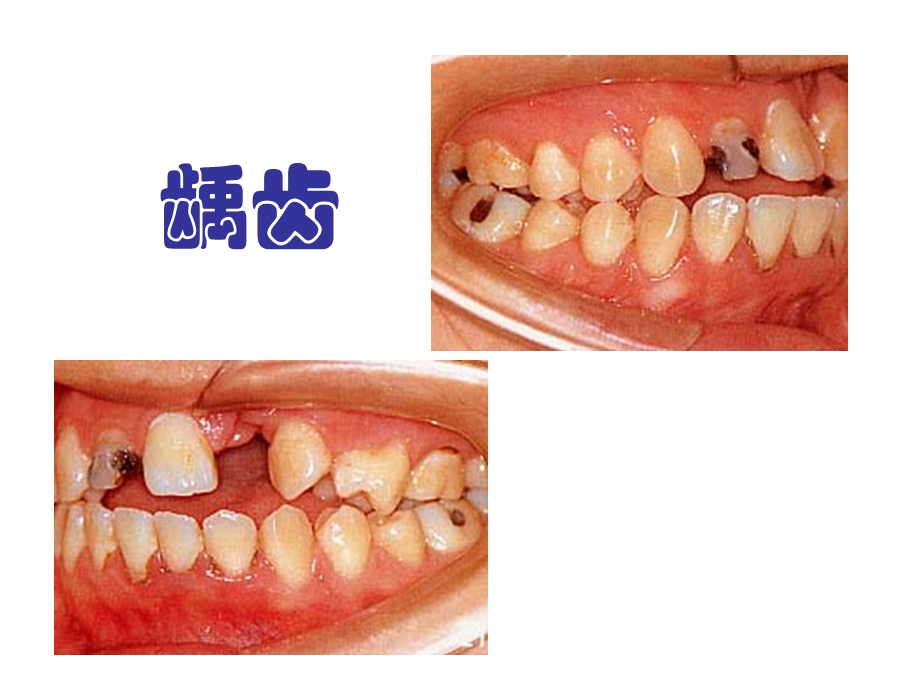 龋齿的预防.ppt.ppt_第3页