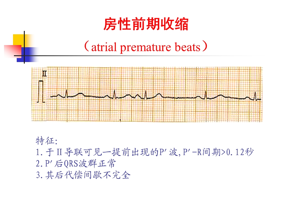 心律失常ppt课程.ppt_第3页