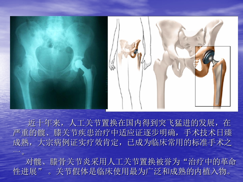 一月快速康复外科处理高危人群的关节置换手术.ppt_第2页