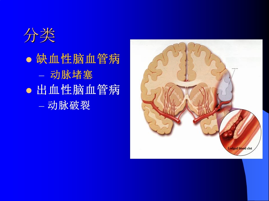 缺血性卒中－Ischemic Stroke.ppt_第3页