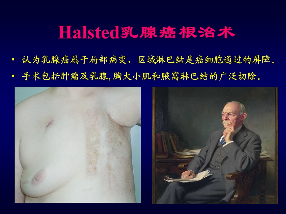 乳腺癌微创.ppt_第3页