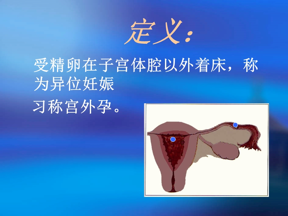 异位妊娠(课件).ppt_第2页