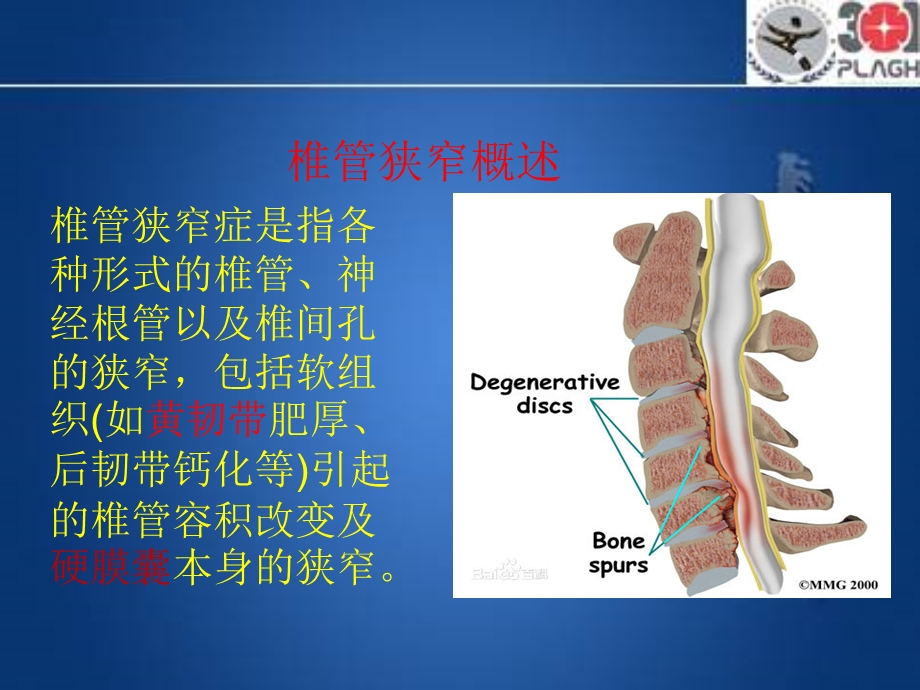 代谢性椎管狭窄.ppt_第2页