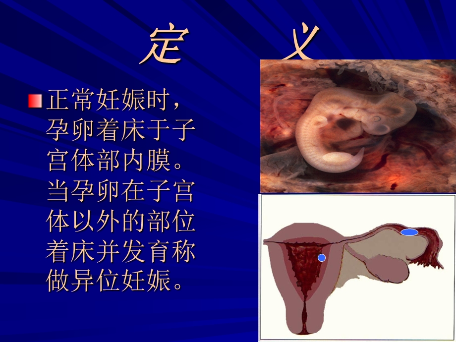 异位妊娠的诊治.ppt_第2页