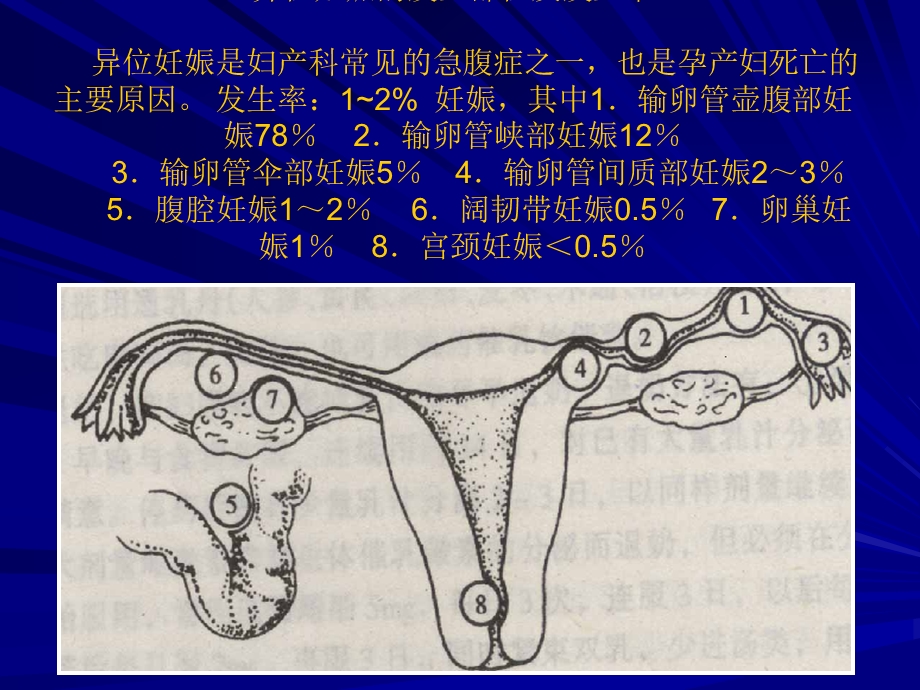 异位妊娠的诊治.ppt_第3页