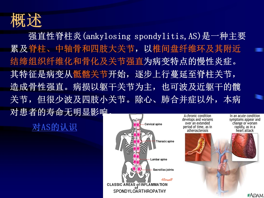 强直性脊柱炎1.ppt_第3页