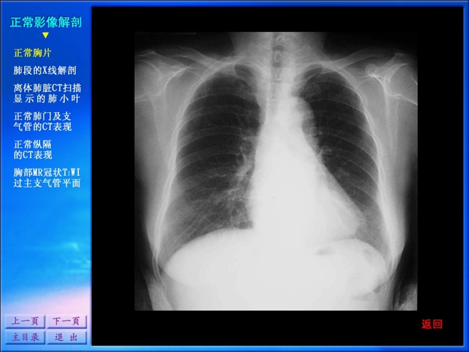 0207影像诊断学系列图谱呼吸系统.ppt_第3页