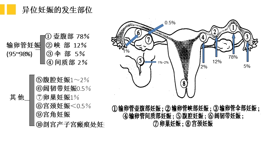 宫外孕的护理查房.ppt_第3页