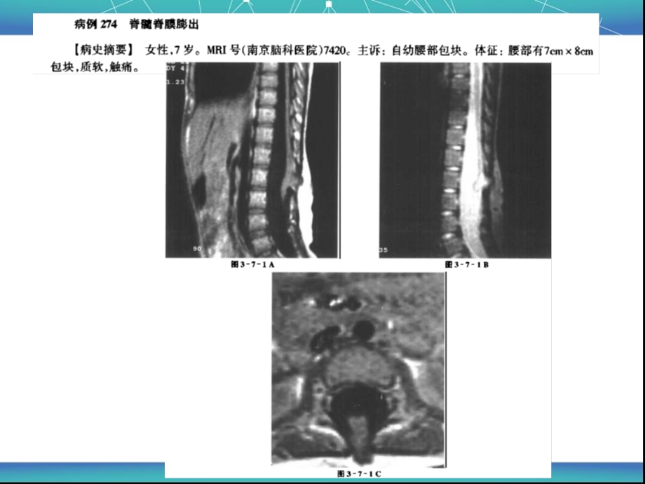 脊髓与脊柱病变MRI诊断1.ppt_第2页