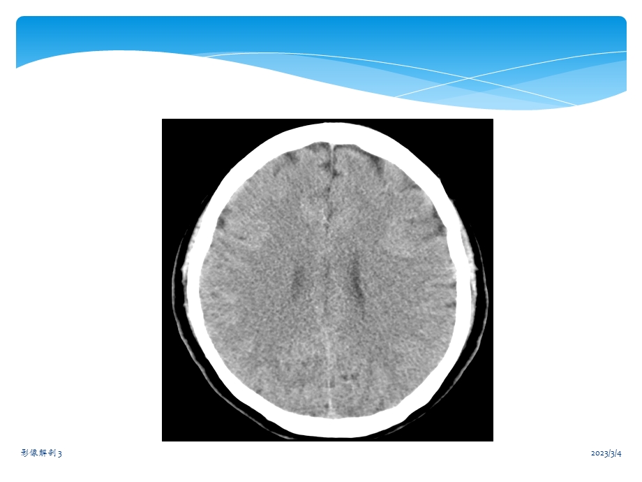 中枢神经系统CT诊断.ppt_第3页