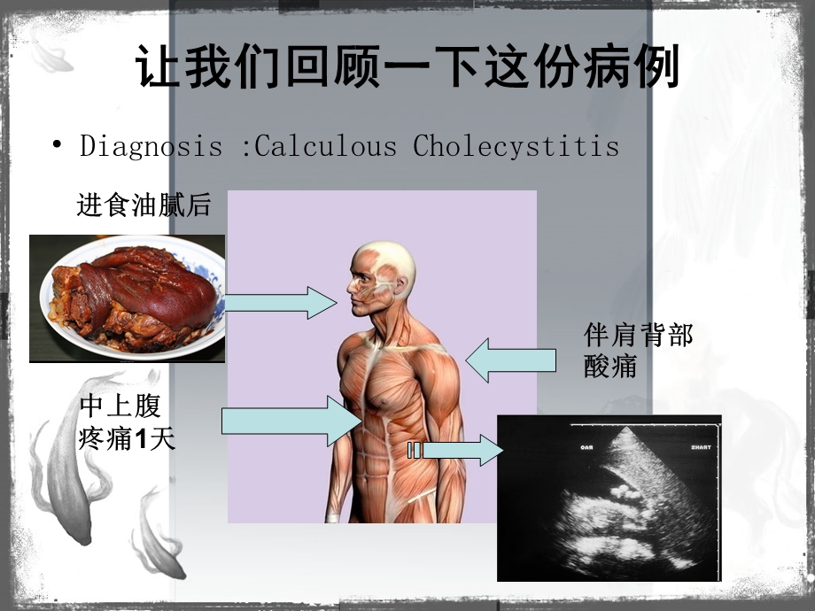 结石性胆囊炎的诊断和治疗.ppt_第2页