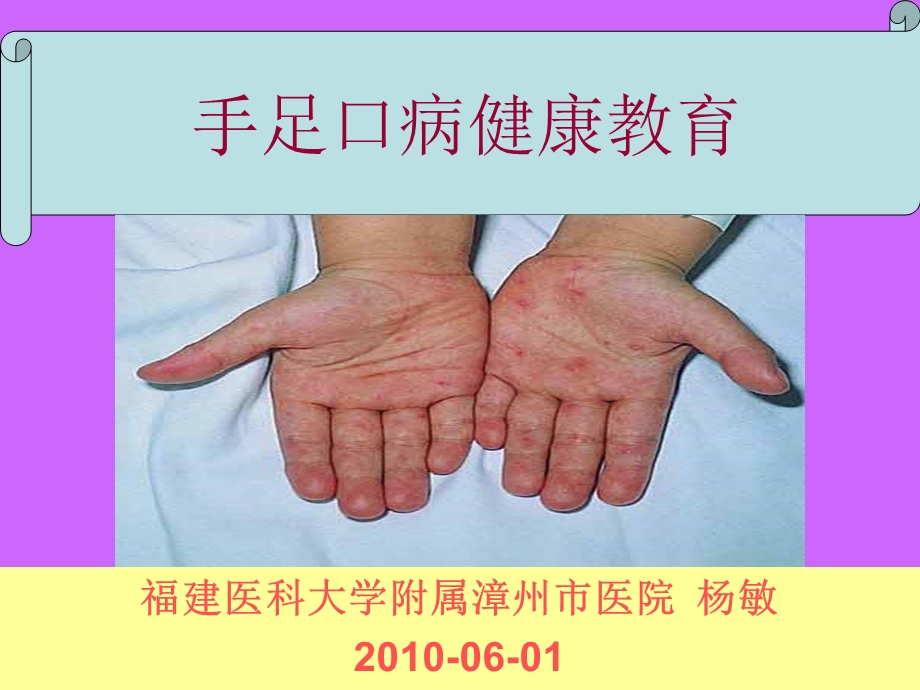 手足口病健康教育.ppt_第1页