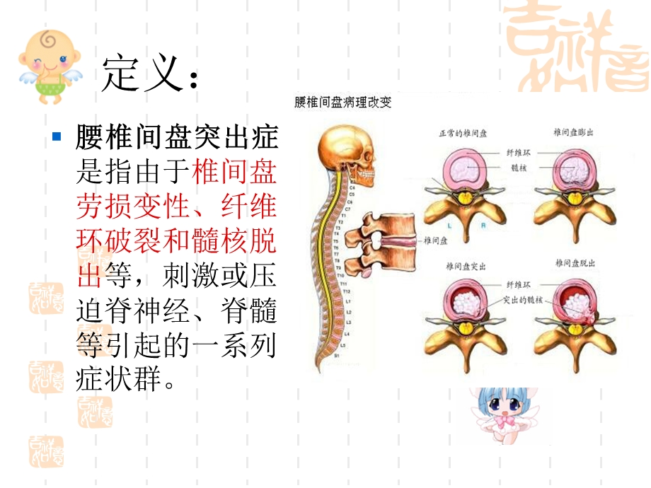 腰椎间盘突出的功能锻炼.ppt_第3页