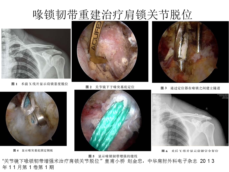 肩关节镜临床应用.ppt_第3页