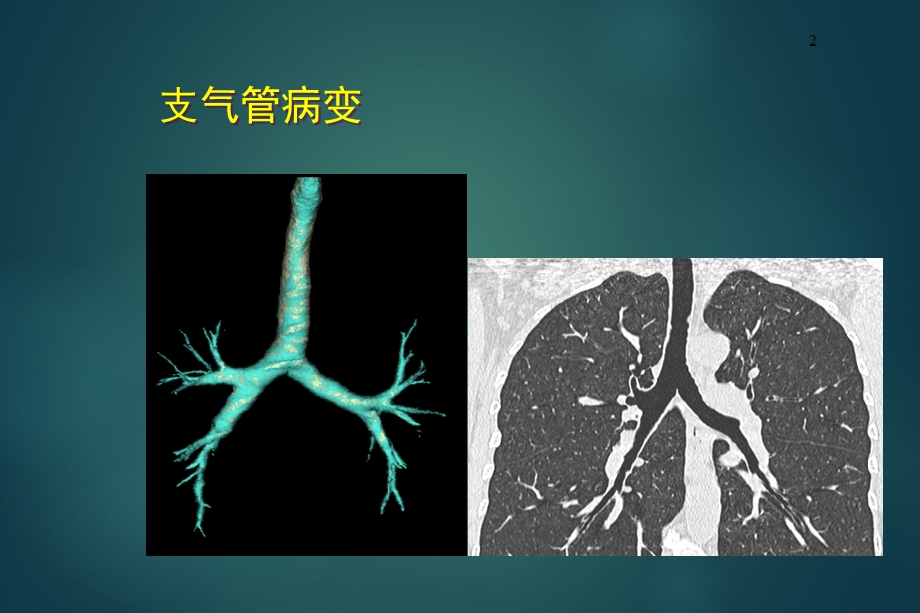 胸部常见病变的影像学诊断.ppt_第2页