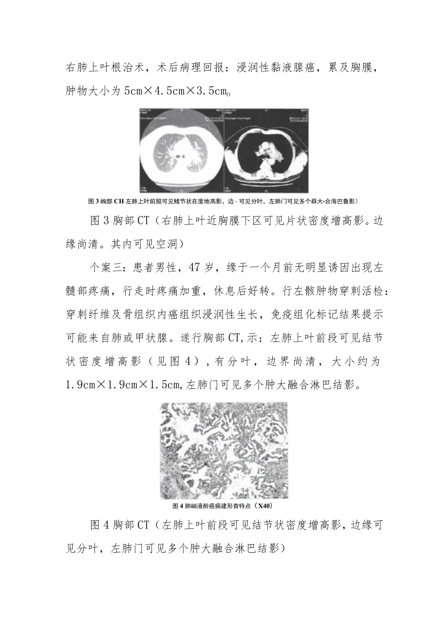 三例肺浸润性黏液腺癌CT诊断分析专题报告.docx_第3页