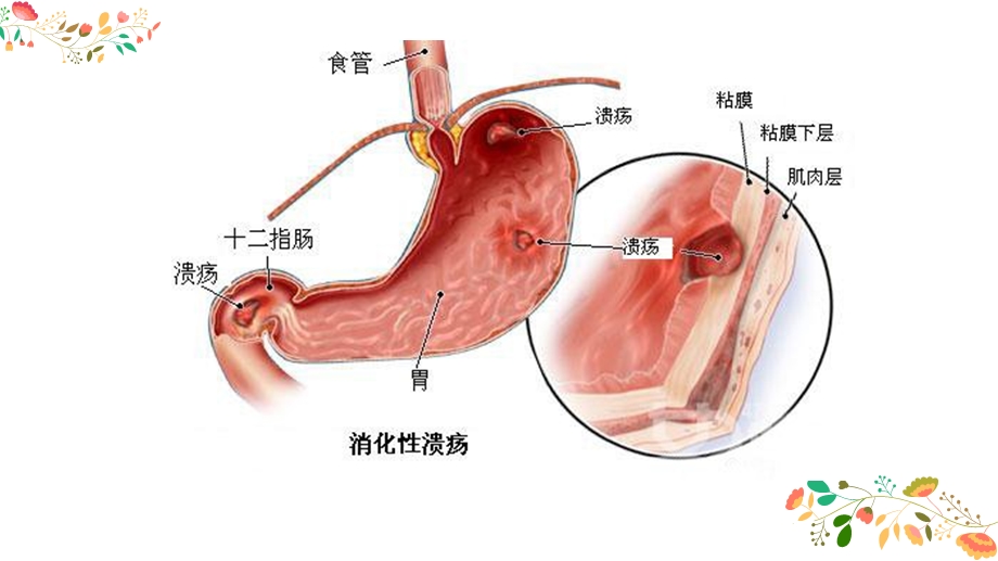 消化性溃疡的护理查房ppt课件.pptx_第3页