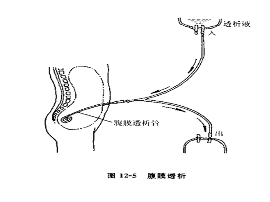 腹膜透析护理课件.ppt_第3页