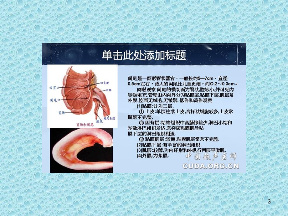 阑尾炎的超声诊断课件.ppt_第3页