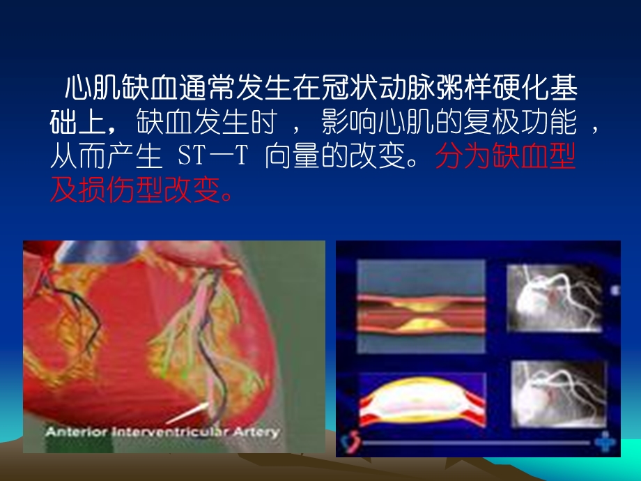 诊断学-心肌缺血心肌梗死课件.ppt_第3页