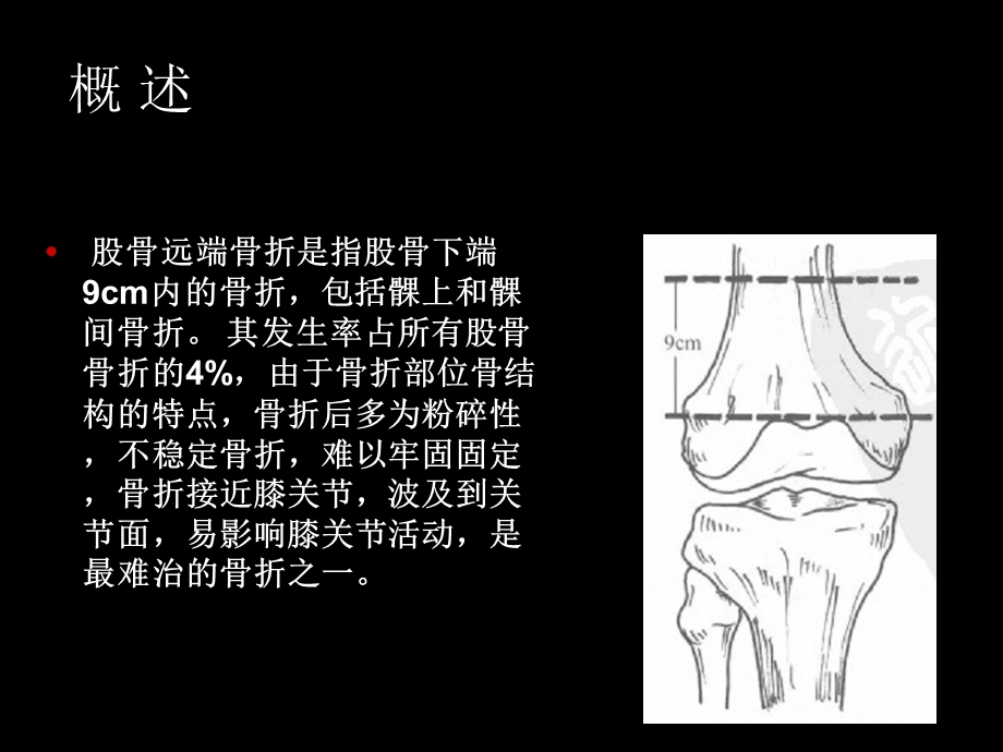 股骨远端骨折临床讲解课件.ppt_第2页