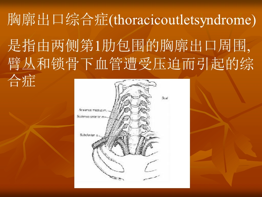 胸廓出口综合症分析课件.ppt_第2页