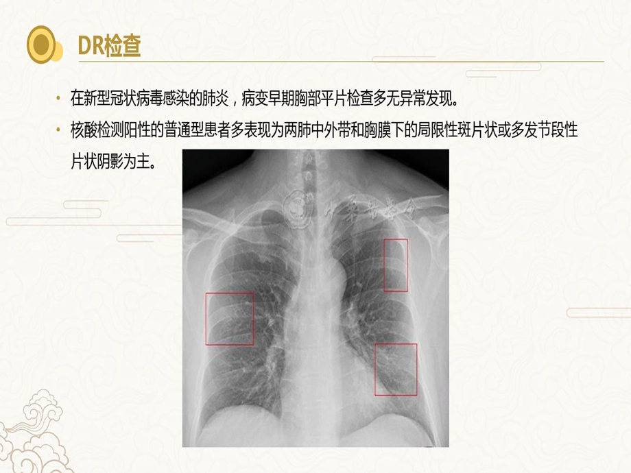 新冠肺炎-影像学演示教学课件.ppt_第3页