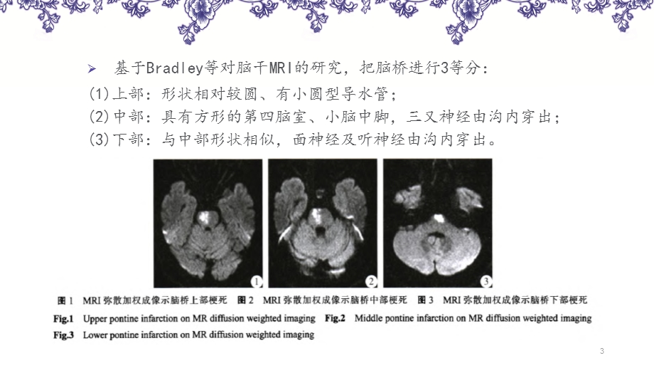 脑桥梗死&孤立性脑桥梗死参考ppt课件.ppt_第3页