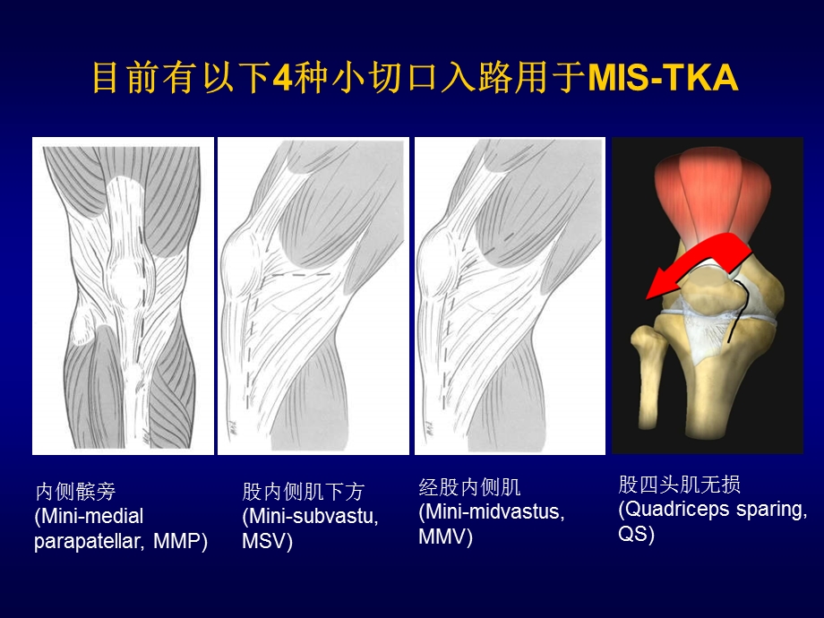 小切口经股内侧肌入路与小切口髌旁内侧入路行课件.pptx_第2页