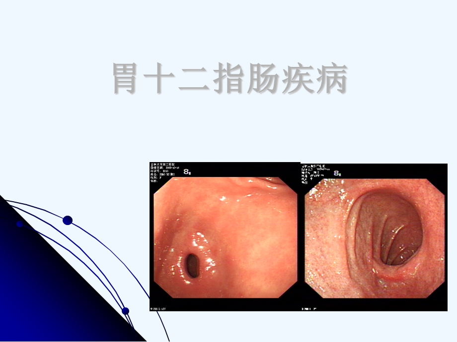 胃十二指肠疾病的内窥镜诊断课件.ppt_第1页