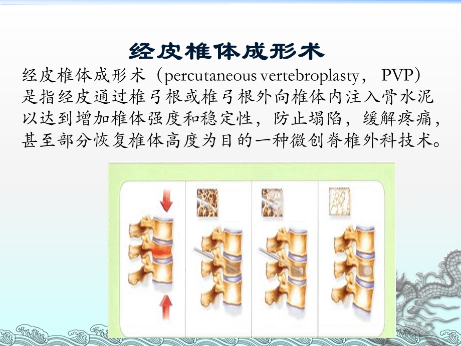 胸腰椎骨折的微创手术治疗讲解课件.ppt_第3页