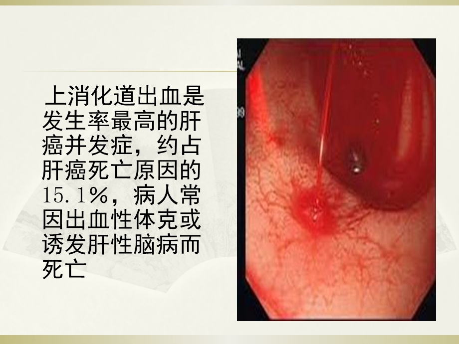 肝癌并上消化道出血的护理课件.ppt_第3页